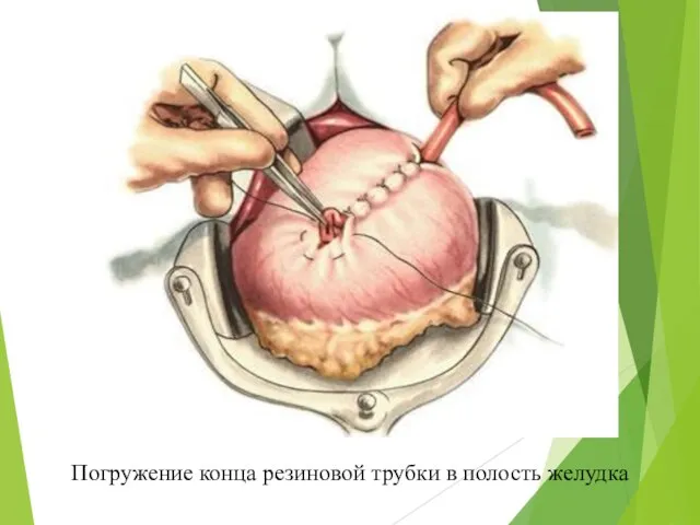 Погружение конца резиновой трубки в полость желудка