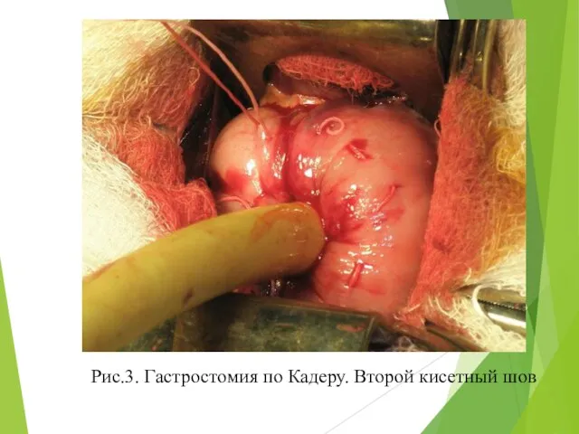 Рис.3. Гастростомия по Кадеру. Второй кисетный шов
