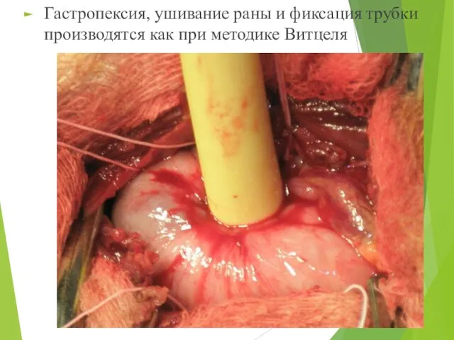 Гастропексия, ушивание раны и фиксация трубки производятся как при методике Витцеля