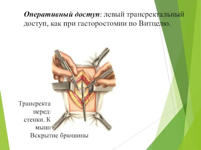 Трансректальный разрез передней брюшной стенки. Кожа и прямая мышца рассечены. Вскрытие