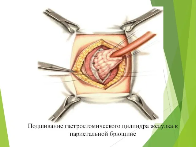 Подшивание гастростомического цилиндра желудка к париетальной брюшине