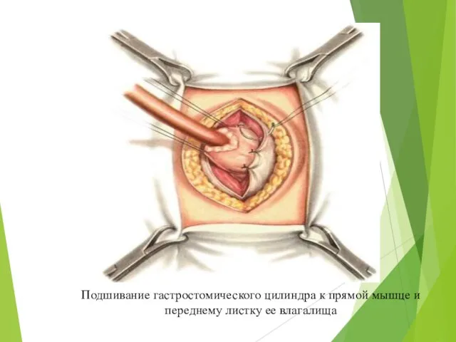 Подшивание гастростомического цилиндра к прямой мышце и переднему листку ее влагалища