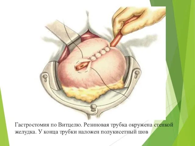 Гастростомия по Витцелю. Резиновая трубка окружена стенкой желудка. У конца трубки наложен полукисетный шов