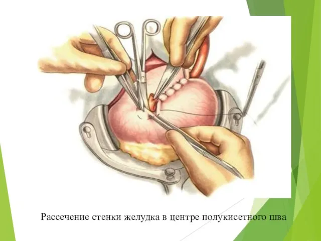 Рассечение стенки желудка в центре полукисетного шва
