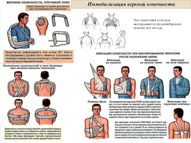 Иммобилизация верхней конечности При переломах ключицы накладывается восьмиобразная повязка или кольца