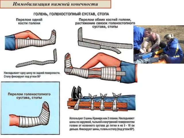 Иммобилизация нижней конечности