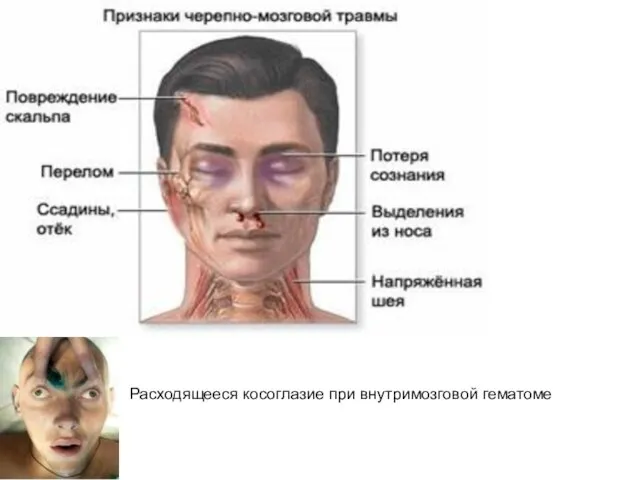 Расходящееся косоглазие при внутримозговой гематоме