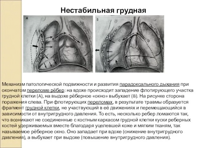 Нестабильная грудная клетка. Механизм патологической подвижности и развития парадоксального дыхания при