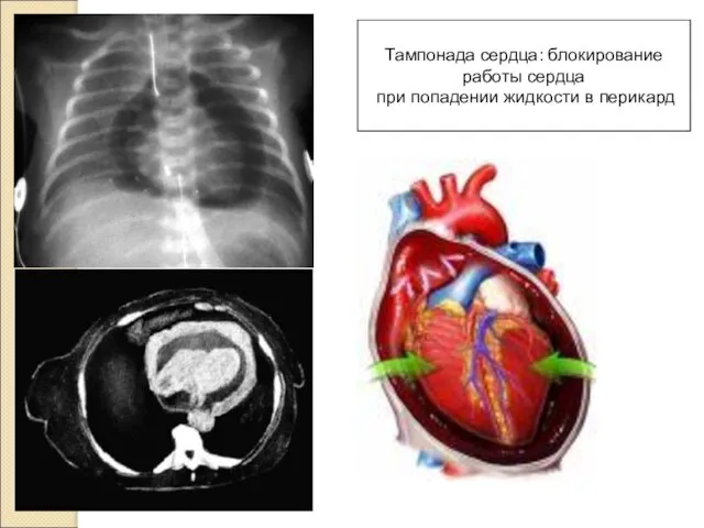 Тампонада сердца: блокирование работы сердца при попадении жидкости в перикард