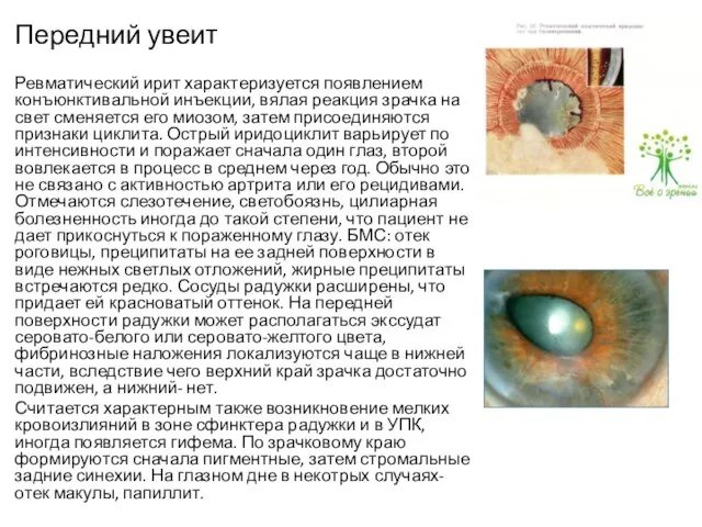 Передний увеит Ревматический ирит характеризуется появлением конъюнктивальной инъекции, вялая реакция зрачка