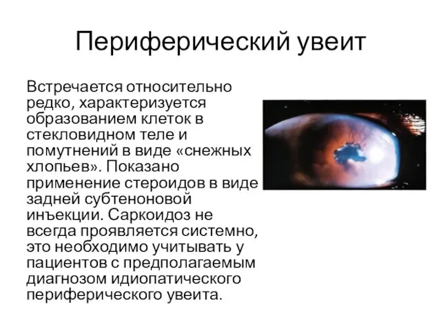 Периферический увеит Встречается относительно редко, характеризуется образованием клеток в стекловидном теле