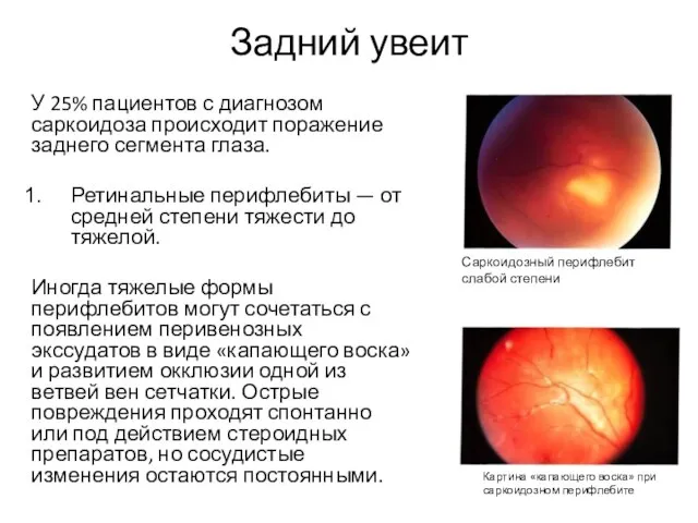Задний увеит У 25% пациентов с диагнозом саркоидоза происходит поражение заднего