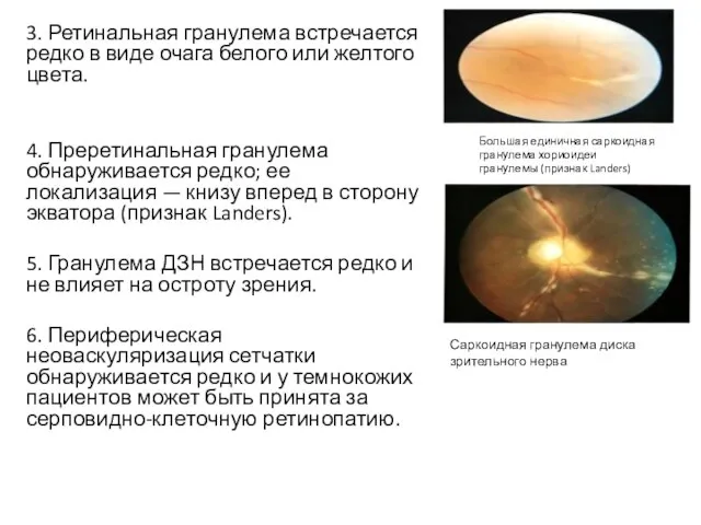 3. Ретинальная гранулема встречается редко в виде очага белого или желтого