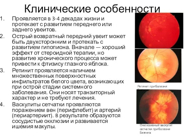 Клинические особенности Проявляется в 3-4 декадах жизни и протекает с развитием