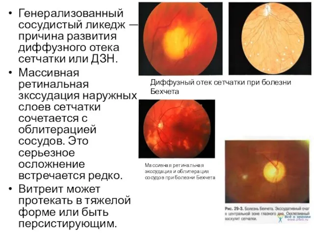 Генерализованный сосудистый ликедж — причина развития диффузного отека сетчатки или ДЗН.