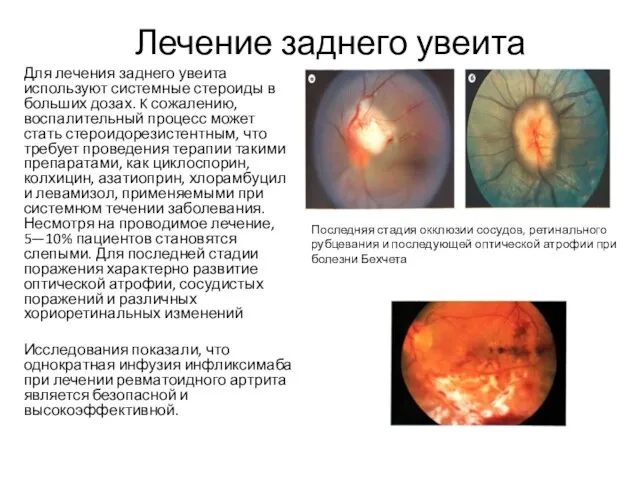 Лечение заднего увеита Для лечения заднего увеита используют системные стероиды в