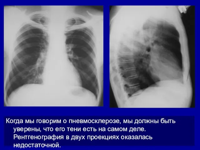 Когда мы говорим о пневмосклерозе, мы должны быть уверены, что его