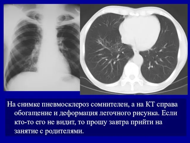 На снимке пневмосклероз сомнителен, а на КТ справа обогащение и деформация