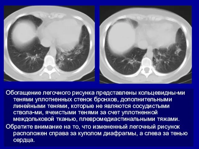 Обогащение легочного рисунка представлены кольцевидны-ми тенями уплотненных стенок бронхов, дополнительными линейными