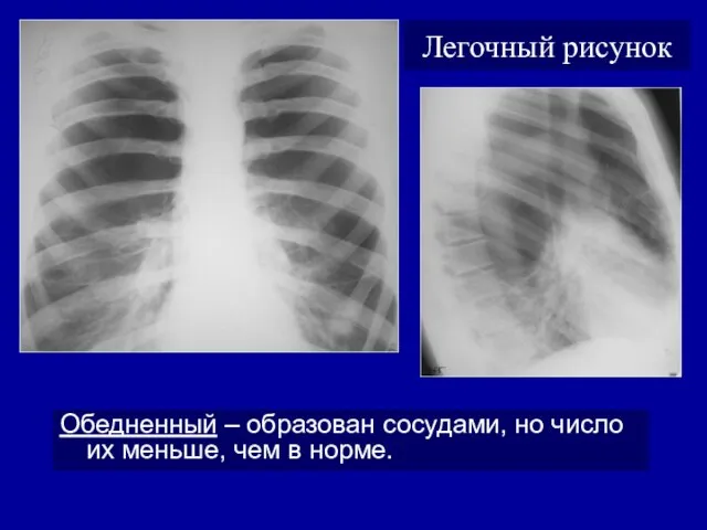 Легочный рисунок Обедненный – образован сосудами, но число их меньше, чем в норме.