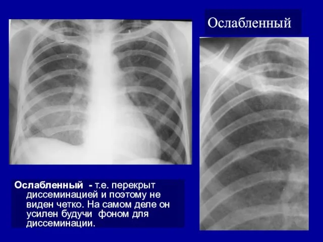 Ослабленный Ослабленный - т.е. перекрыт диссеминацией и поэтому не виден четко.