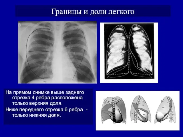 Границы и доли легкого На прямом снимке выше заднего отрезка 4