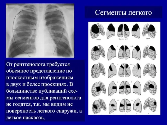 Сегменты легкого От рентгенолога требуется объемное представление по плоскостным изображениям в