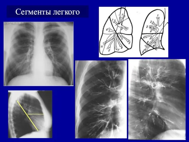 Сегменты легкого