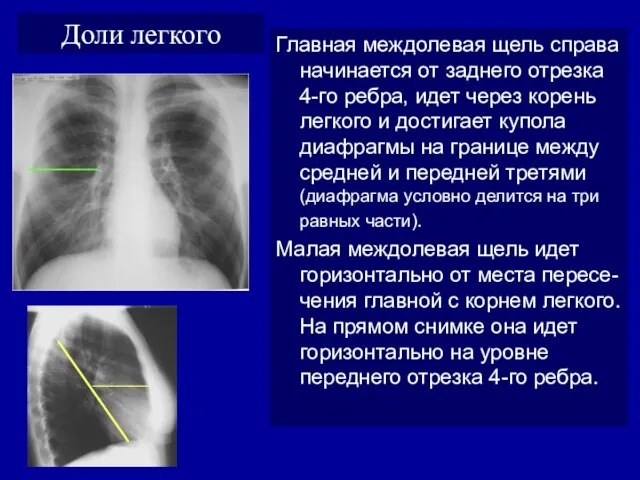 Доли легкого Главная междолевая щель справа начинается от заднего отрезка 4-го