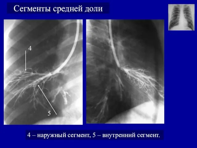 Сегменты средней доли 4 5 4 – наружный сегмент, 5 – внутренний сегмент.