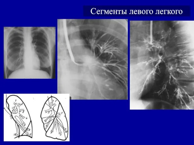 Сегменты левого легкого