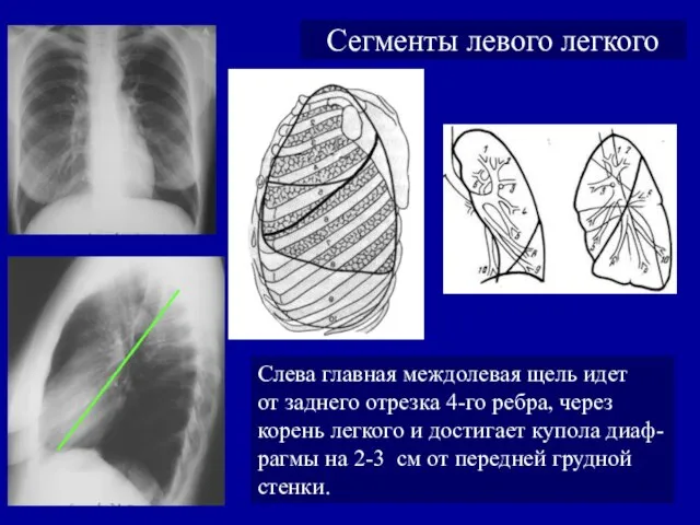 Сегменты левого легкого Слева главная междолевая щель идет от заднего отрезка