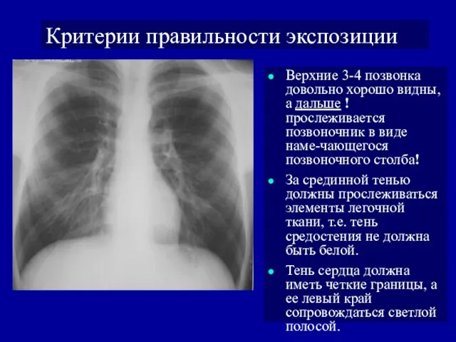 Критерии правильности экспозиции Верхние 3-4 позвонка довольно хорошо видны, а дальше