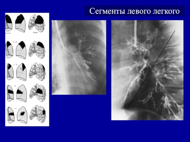 Сегменты левого легкого