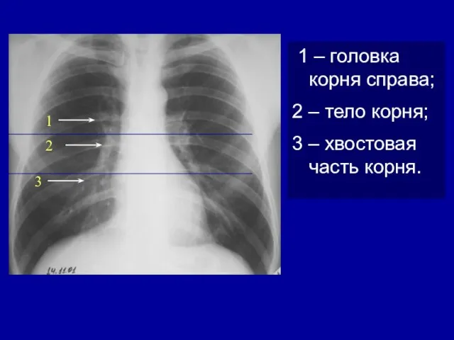 1 – головка корня справа; 2 – тело корня; 3 –