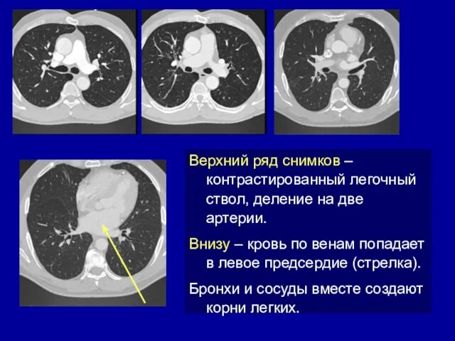 Верхний ряд снимков – контрастированный легочный ствол, деление на две артерии.