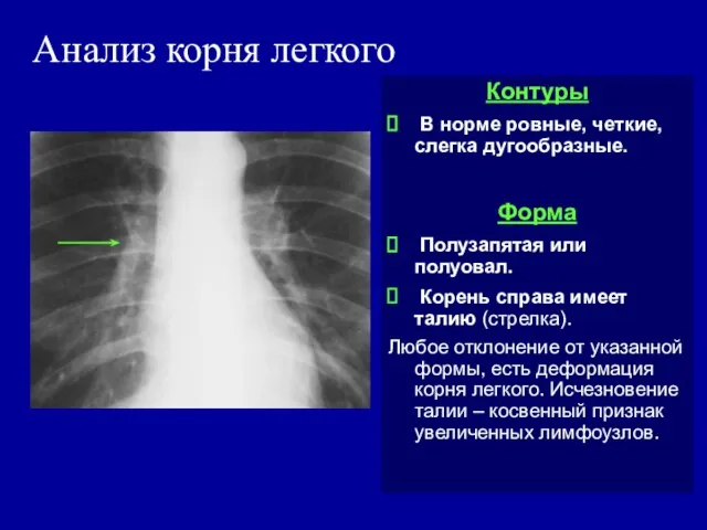 Анализ корня легкого Контуры В норме ровные, четкие, слегка дугообразные. Форма