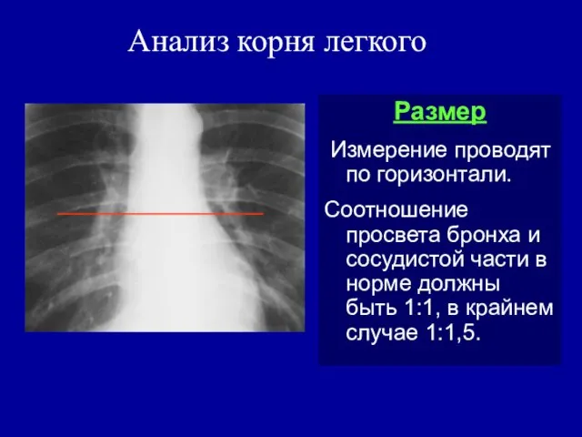 Анализ корня легкого Размер Измерение проводят по горизонтали. Соотношение просвета бронха