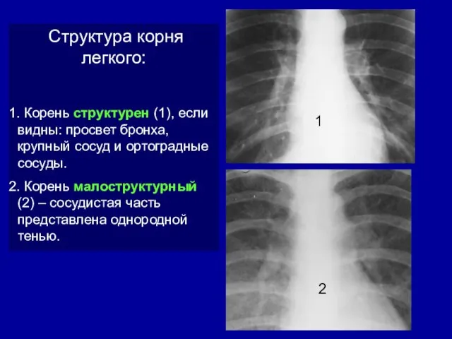 Структура корня легкого: Корень структурен (1), если видны: просвет бронха, крупный