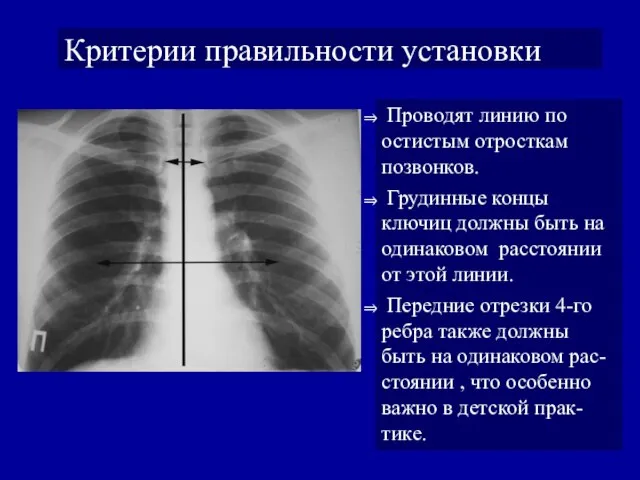 Критерии правильности установки Проводят линию по остистым отросткам позвонков. Грудинные концы