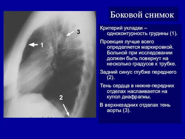 Боковой снимок Критерий укладки – одноконтурность грудины (1). Проекция лучше всего