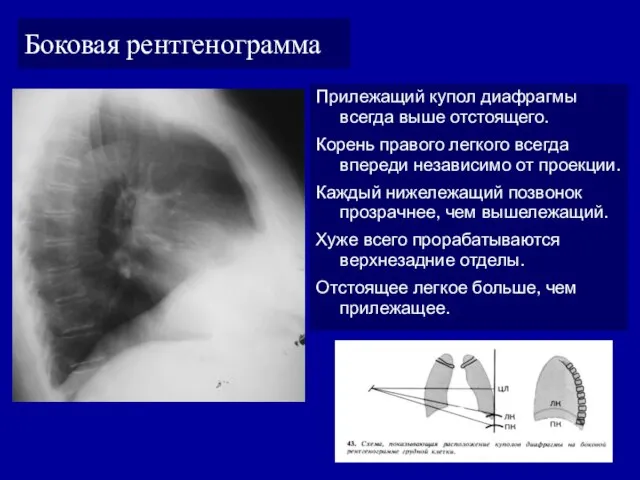 Боковая рентгенограмма Прилежащий купол диафрагмы всегда выше отстоящего. Корень правого легкого