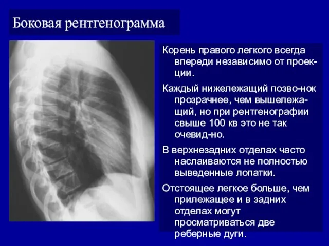 Боковая рентгенограмма Корень правого легкого всегда впереди независимо от проек-ции. Каждый