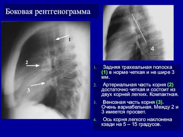 Боковая рентгенограмма Задняя трахеальная полоска (1) в норме четкая и не