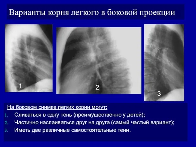 Варианты корня легкого в боковой проекции На боковом снимке легких корни