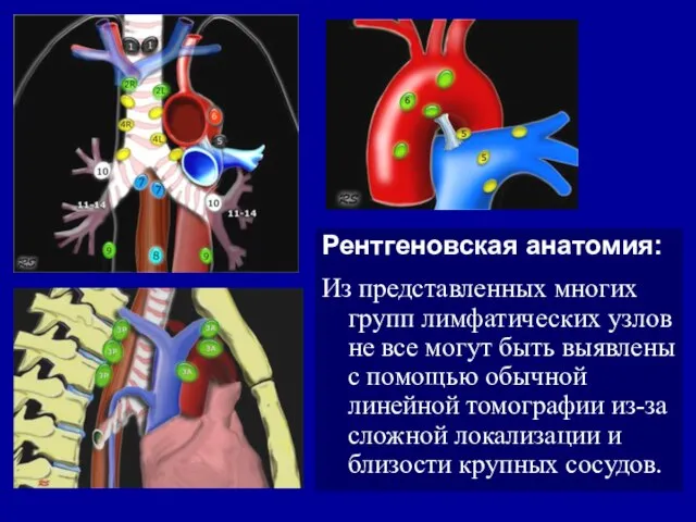 Рентгеновская анатомия: Из представленных многих групп лимфатических узлов не все могут