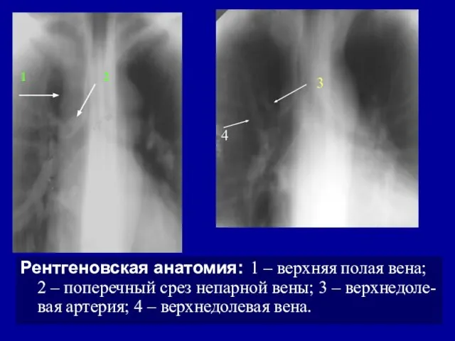 Рентгеновская анатомия: 1 – верхняя полая вена; 2 – поперечный срез