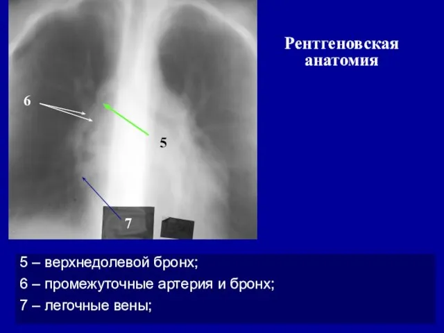 5 – верхнедолевой бронх; 6 – промежуточные артерия и бронх; 7