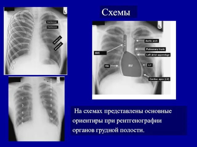 Схемы На схемах представлены основные ориентиры при рентгенографии органов грудной полости.