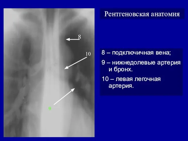 Рентгеновская анатомия 8 – подключичная вена; 9 – нижнедолевые артерия и